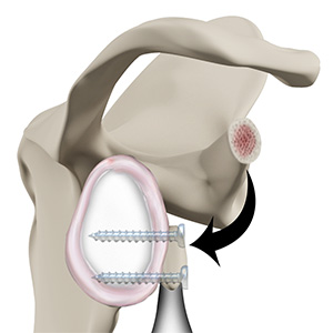 Latarjet Procedure pic 